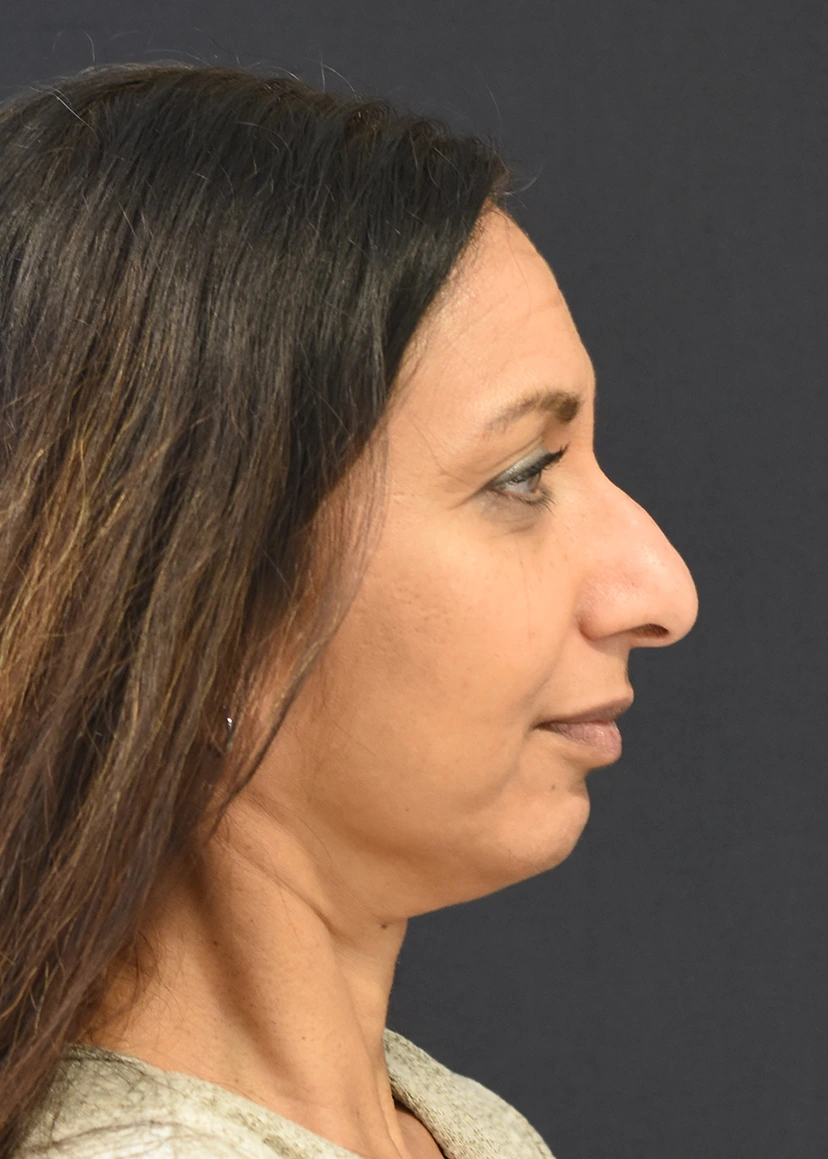 Rhinoplasty Patient 10 Set 3 Before
